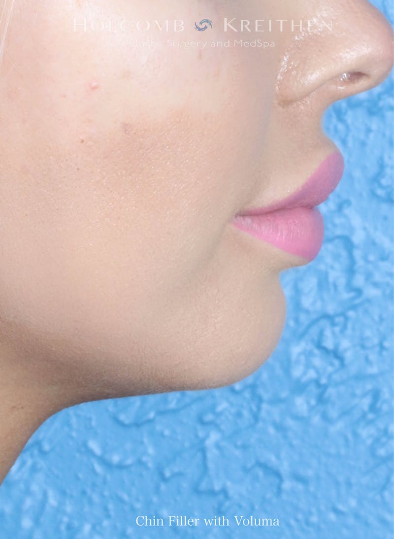 Filler Before & After Gallery - Patient 394338 - Image 1