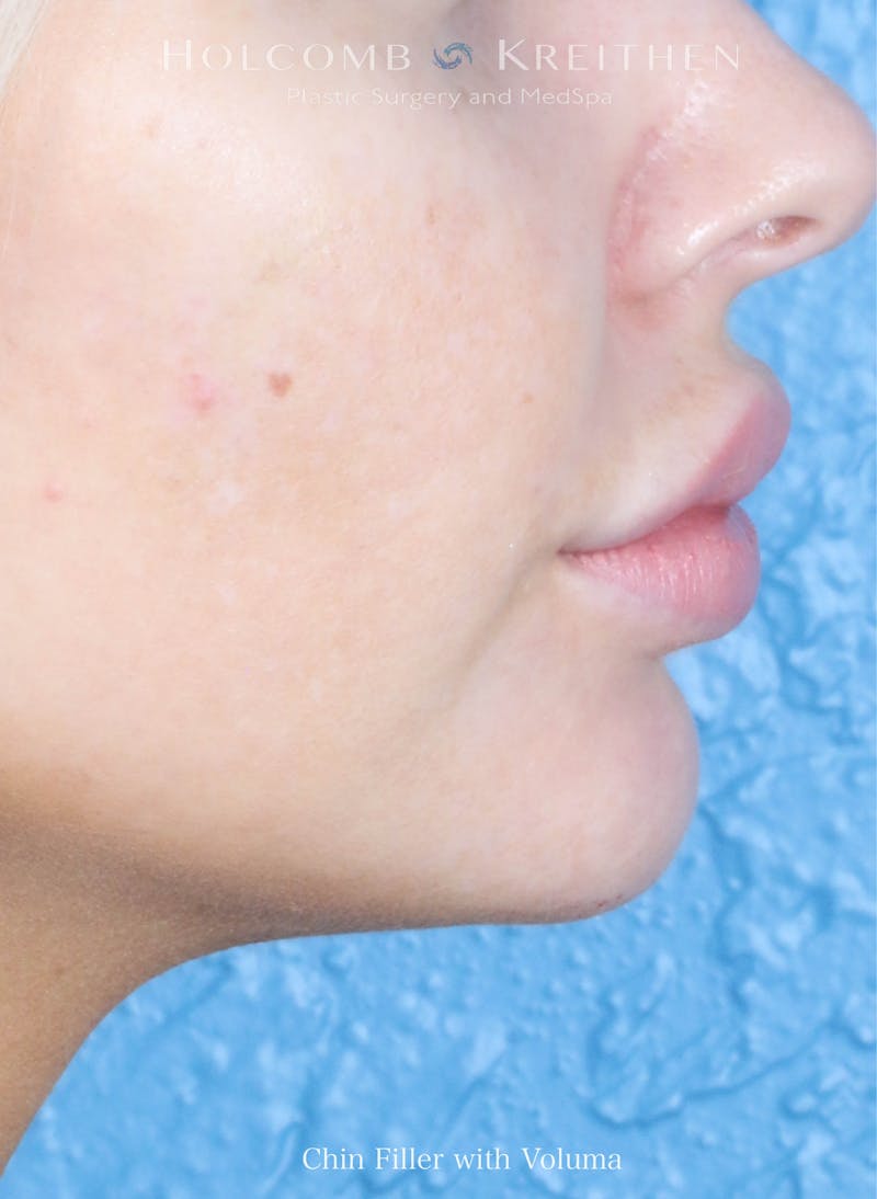Filler Before & After Gallery - Patient 394338 - Image 2