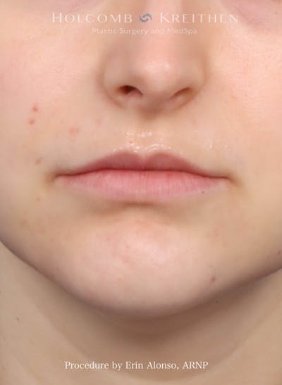 Filler Before & After Gallery - Patient 218903 - Image 1