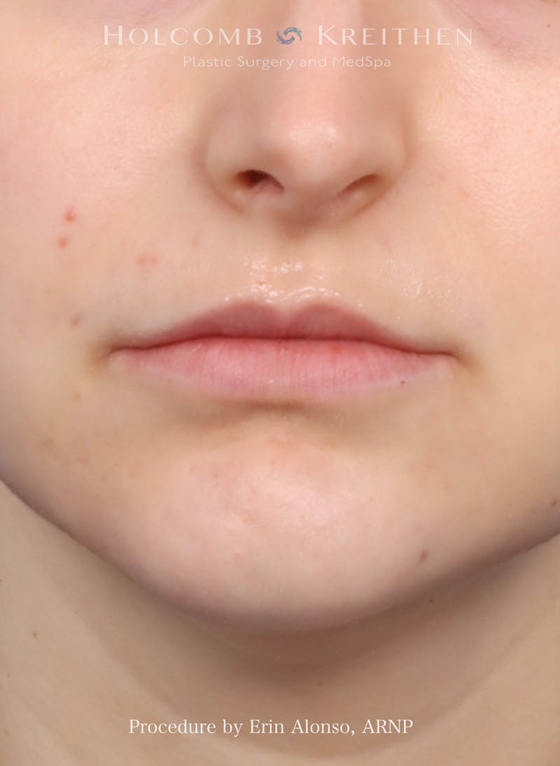 Filler Before & After Gallery - Patient 218903 - Image 1