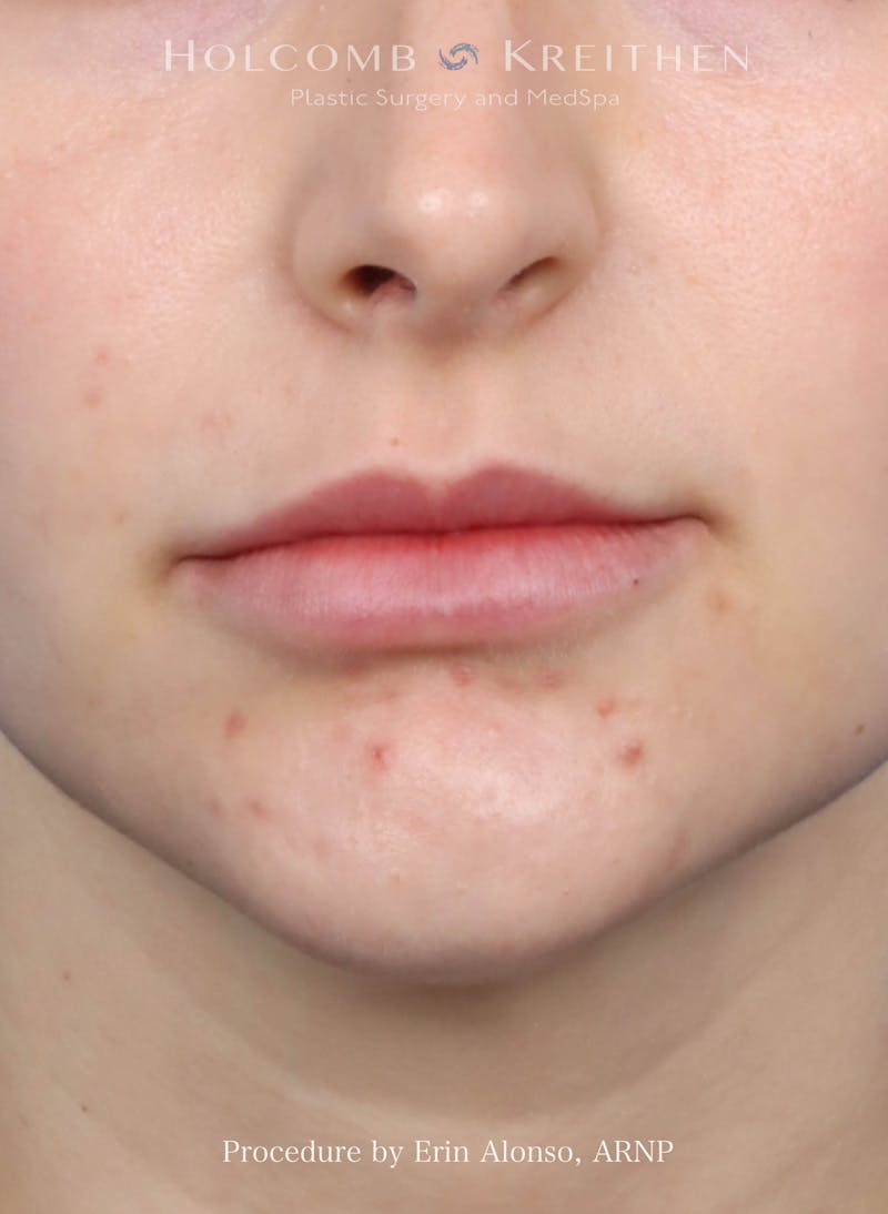 Filler Before & After Gallery - Patient 218903 - Image 2