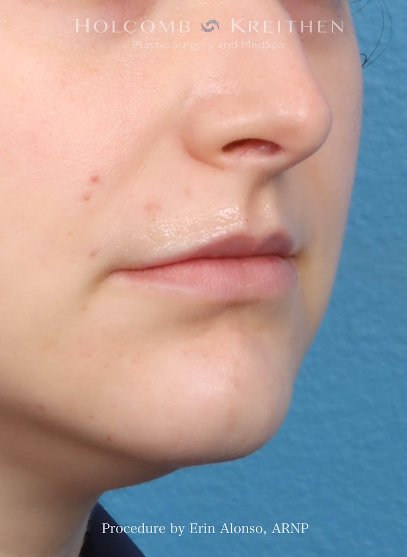Filler Before & After Gallery - Patient 218903 - Image 3