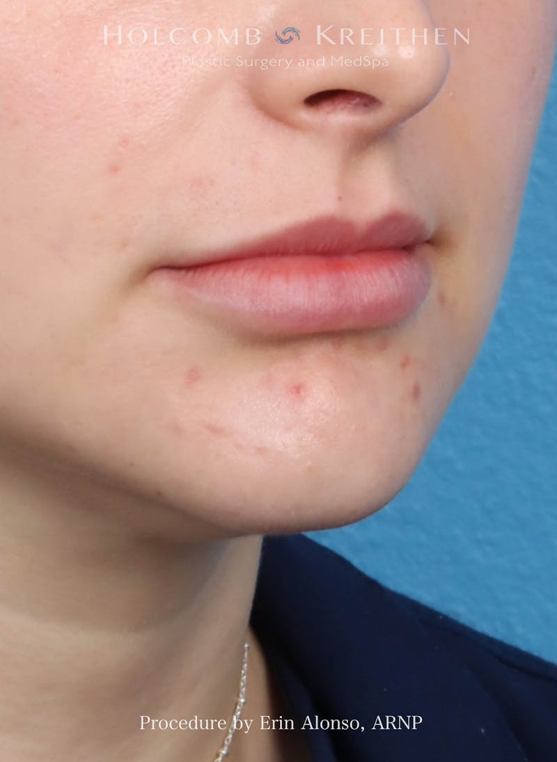 Filler Before & After Gallery - Patient 218903 - Image 4