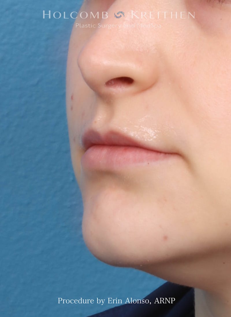 Filler Before & After Gallery - Patient 218903 - Image 5