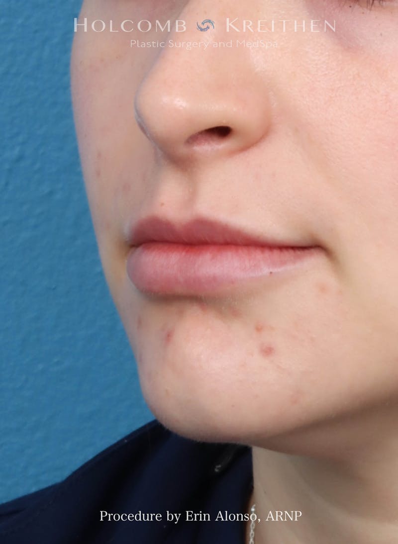 Filler Before & After Gallery - Patient 218903 - Image 6