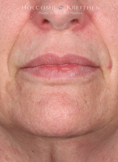 Filler Before & After Gallery - Patient 146235 - Image 1