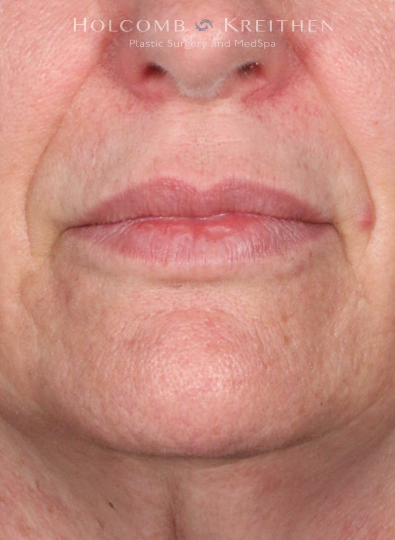 Filler Before & After Gallery - Patient 146235 - Image 1