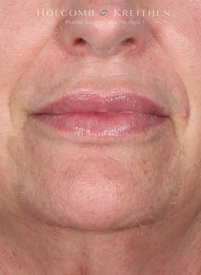 Filler Before & After Gallery - Patient 146235 - Image 2