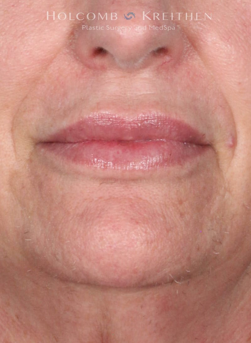 Filler Before & After Gallery - Patient 146235 - Image 2