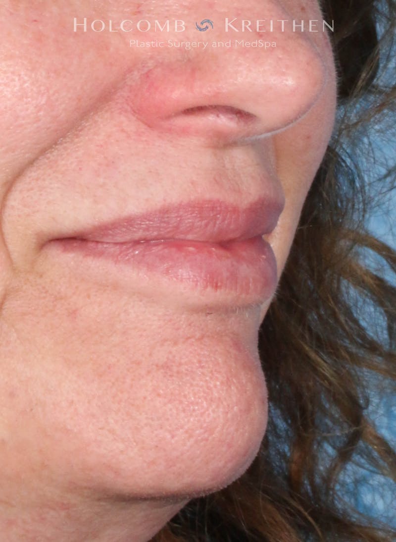 Filler Before & After Gallery - Patient 146235 - Image 3