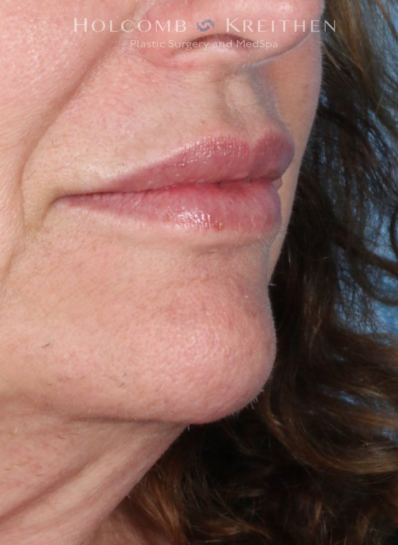 Filler Before & After Gallery - Patient 146235 - Image 4