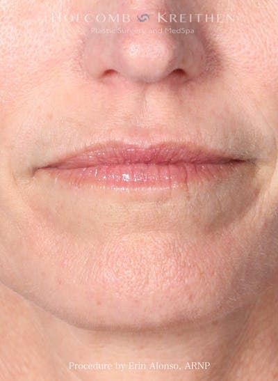 Filler Before & After Gallery - Patient 333720 - Image 1