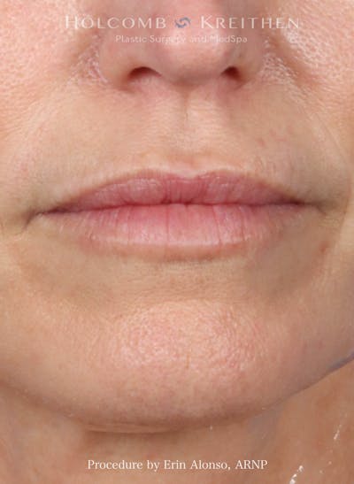 Filler Before & After Gallery - Patient 333720 - Image 2