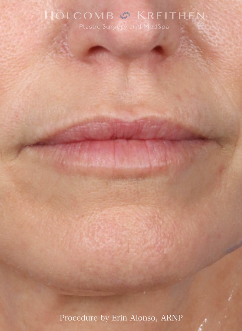 Filler Before & After Gallery - Patient 333720 - Image 2