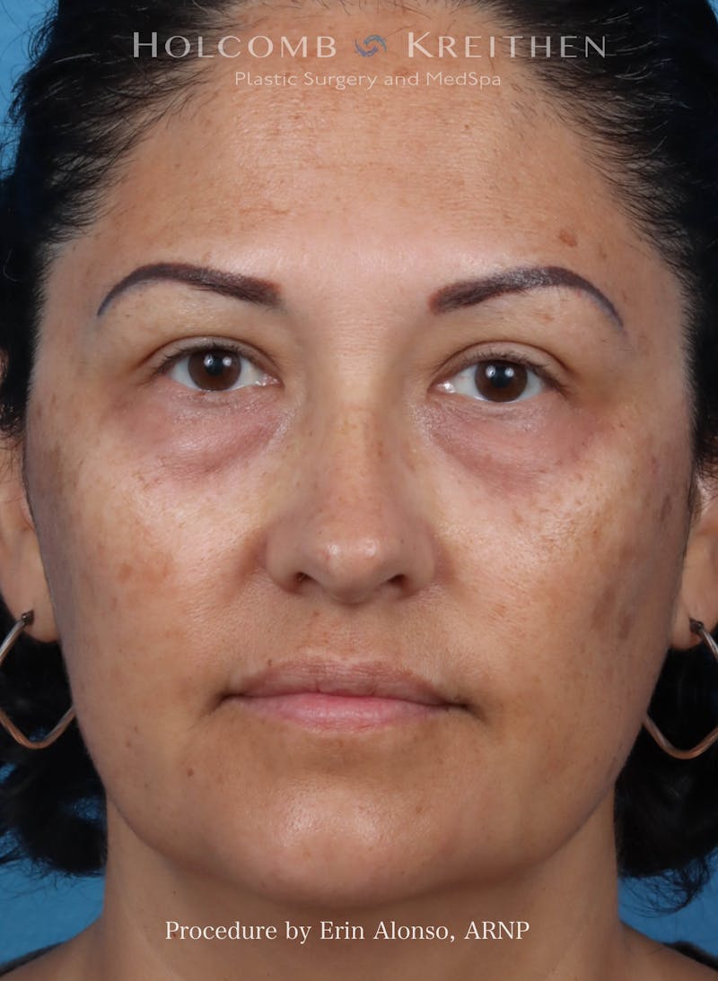 Morpheus  Before & After Gallery - Patient 123937 - Image 1