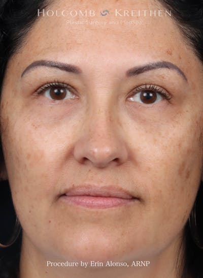 Morpheus  Before & After Gallery - Patient 123937 - Image 2