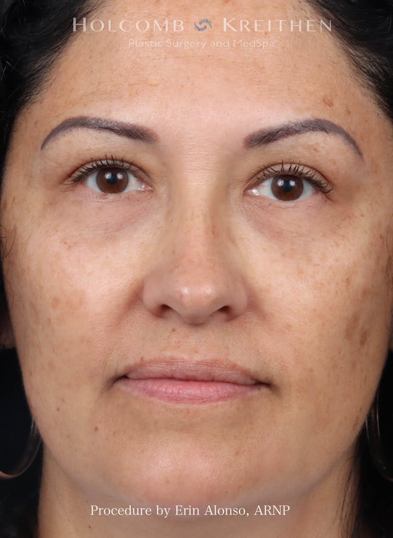 Morpheus  Before & After Gallery - Patient 123937 - Image 2