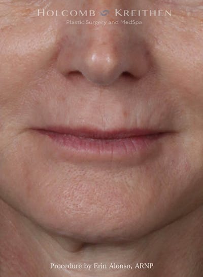 Filler Before & After Gallery - Patient 350835 - Image 1