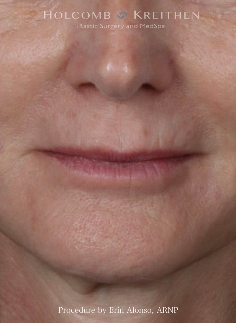 Filler Before & After Gallery - Patient 350835 - Image 1