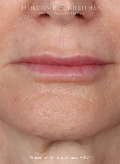 Filler Before & After Gallery - Patient 350835 - Image 2