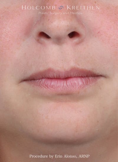 Filler Before & After Gallery - Patient 445774 - Image 1