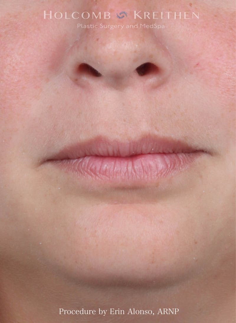 Filler Before & After Gallery - Patient 445774 - Image 1