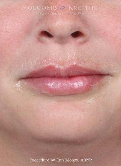 Filler Before & After Gallery - Patient 445774 - Image 2