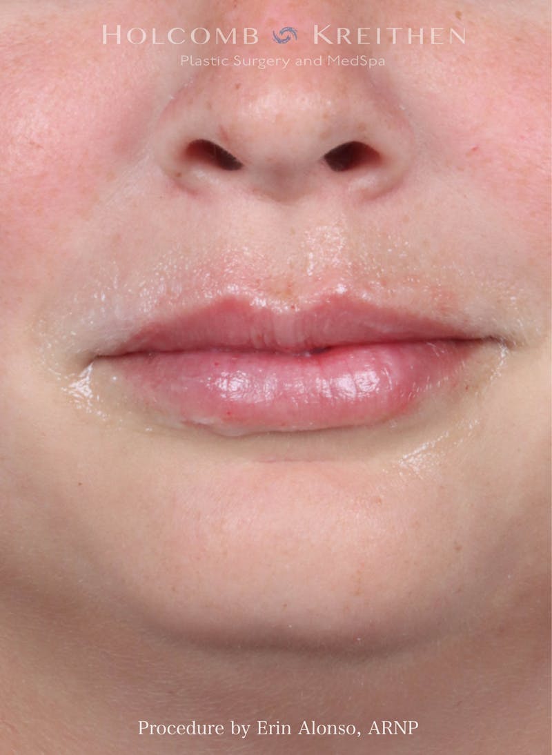 Filler Before & After Gallery - Patient 445774 - Image 2