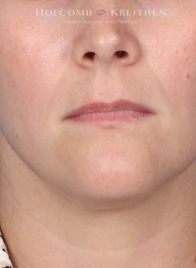 Filler Before & After Gallery - Patient 425607 - Image 1