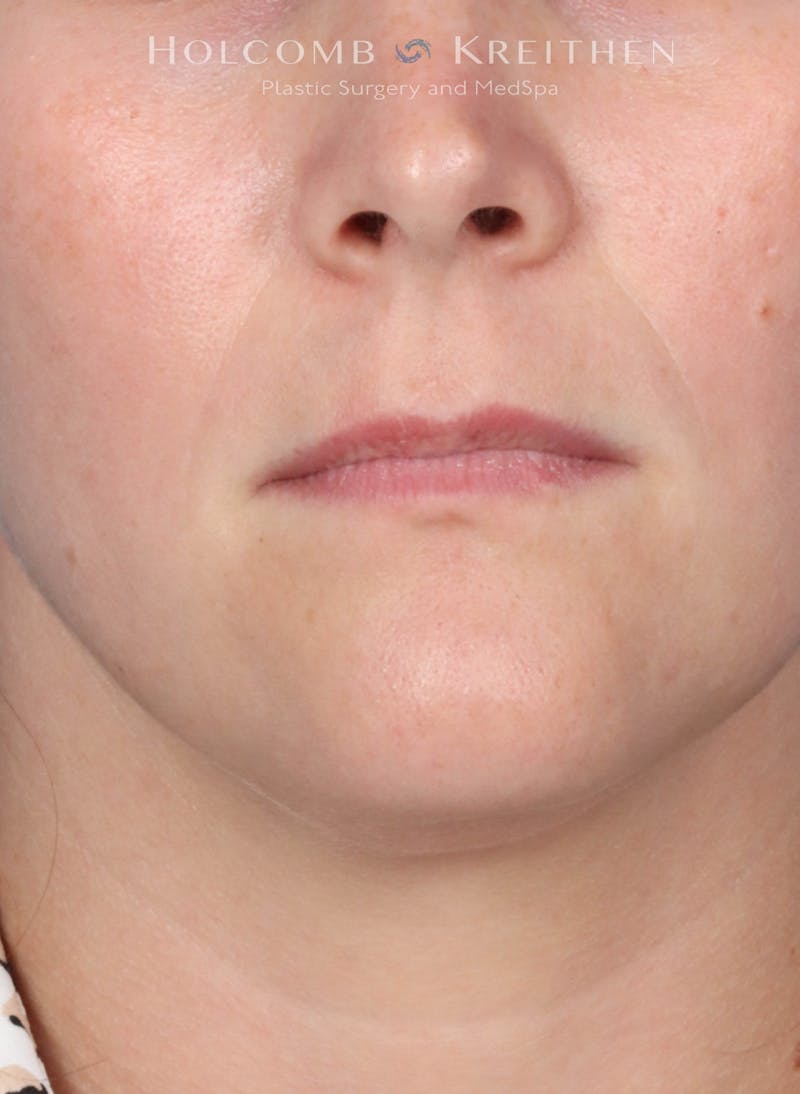 Filler Before & After Gallery - Patient 425607 - Image 1