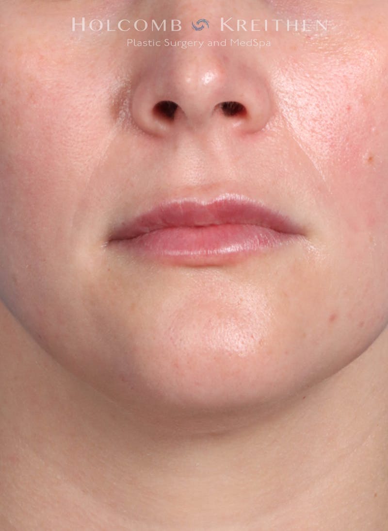 Filler Before & After Gallery - Patient 425607 - Image 2