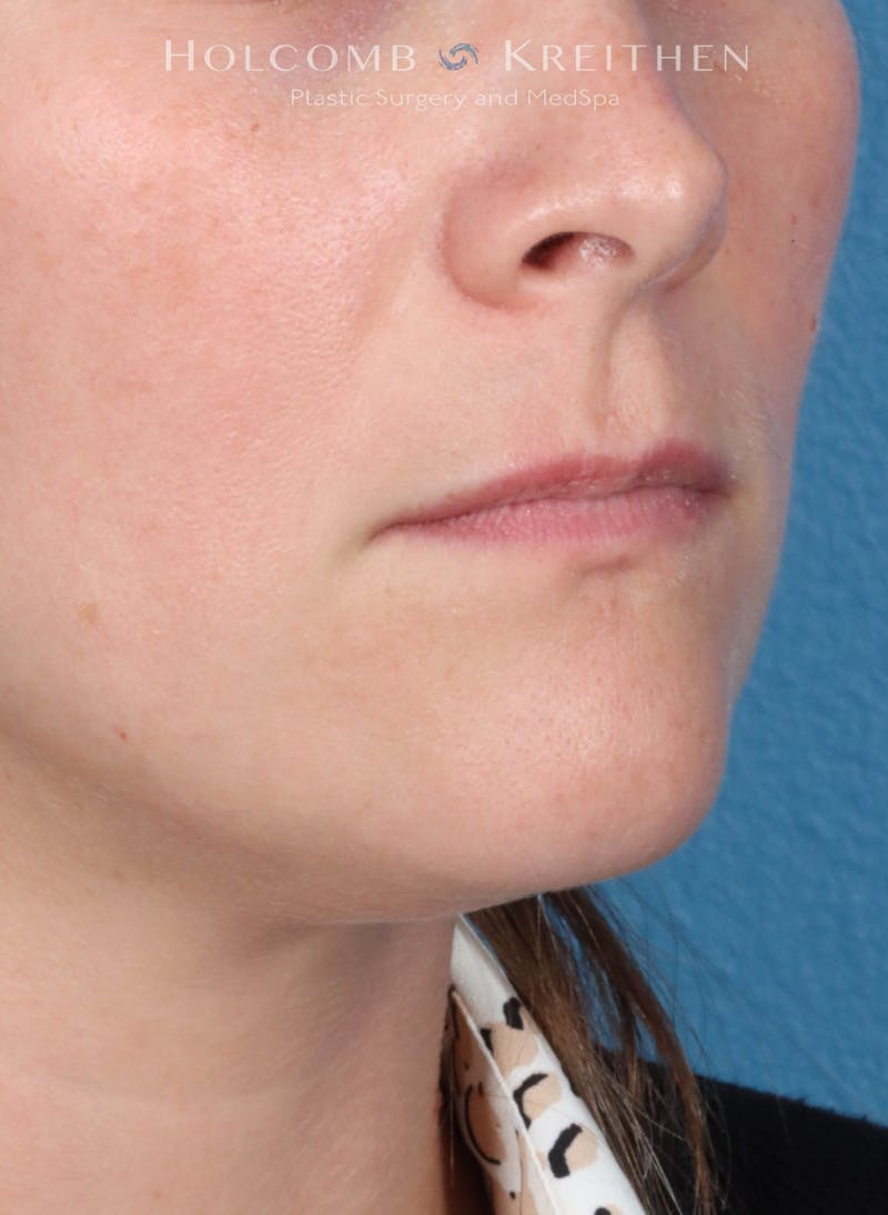 Filler Before & After Gallery - Patient 425607 - Image 3