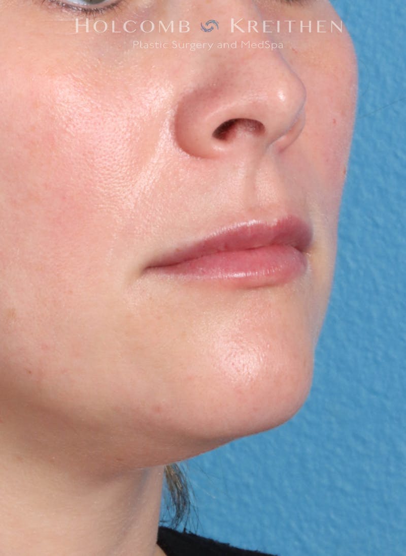 Filler Before & After Gallery - Patient 425607 - Image 4