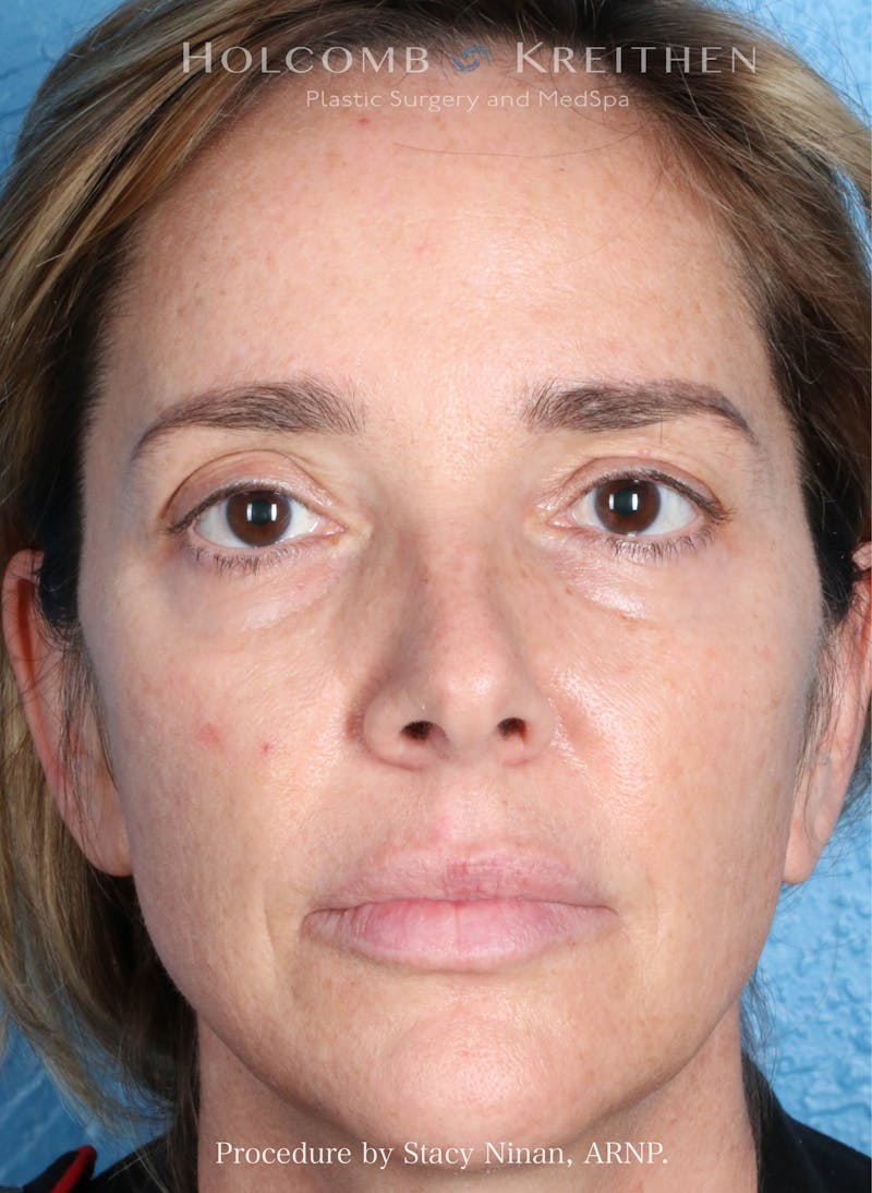 Filler Before & After Gallery - Patient 308894 - Image 1