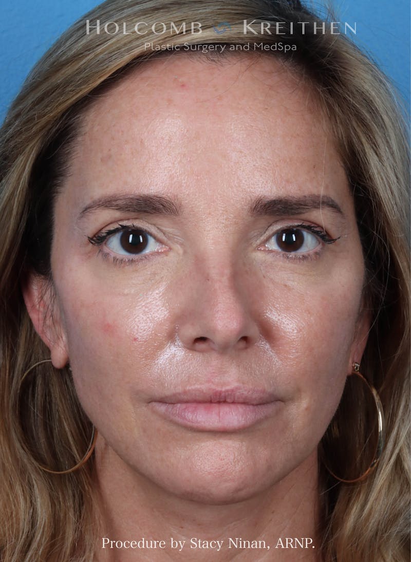 Filler Before & After Gallery - Patient 308894 - Image 2