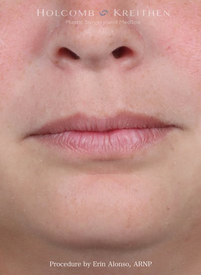 Filler Before & After Gallery - Patient 512794 - Image 1