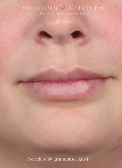 Filler Before & After Gallery - Patient 512794 - Image 2
