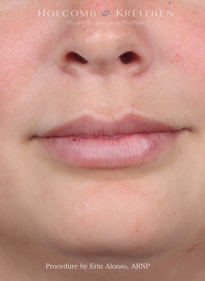 Filler Before & After Gallery - Patient 512794 - Image 2