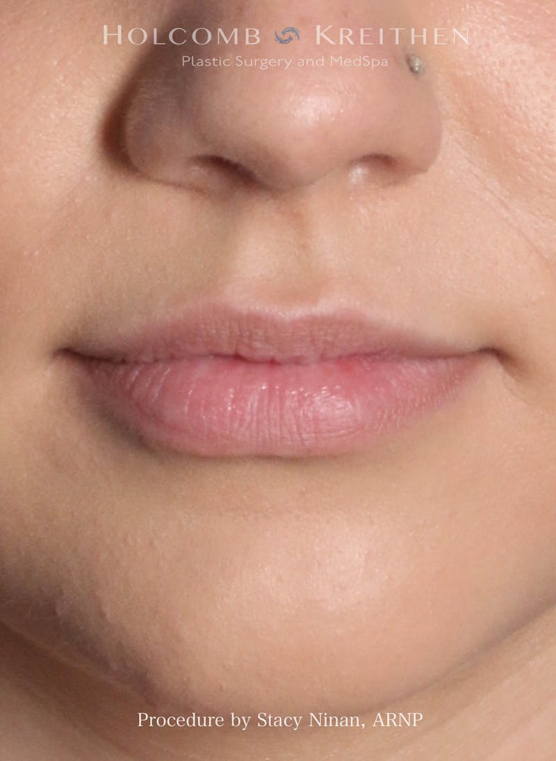 Filler Before & After Gallery - Patient 317568 - Image 1