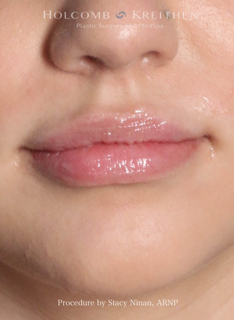 Filler Before & After Gallery - Patient 317568 - Image 2