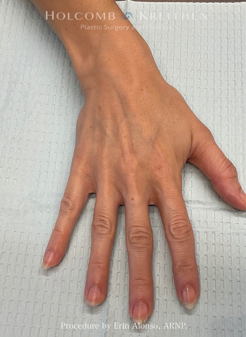 Filler Before & After Gallery - Patient 103393 - Image 1
