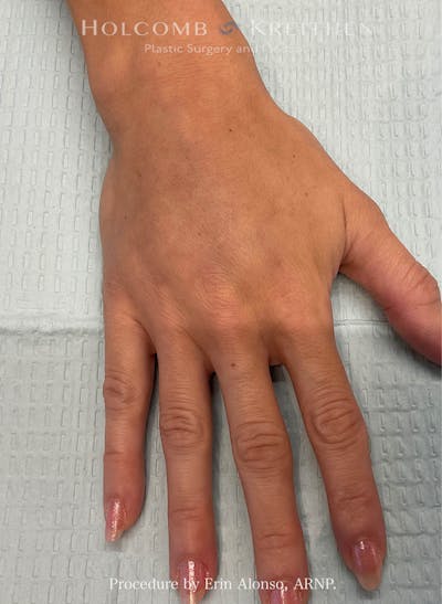 Filler Before & After Gallery - Patient 103393 - Image 2