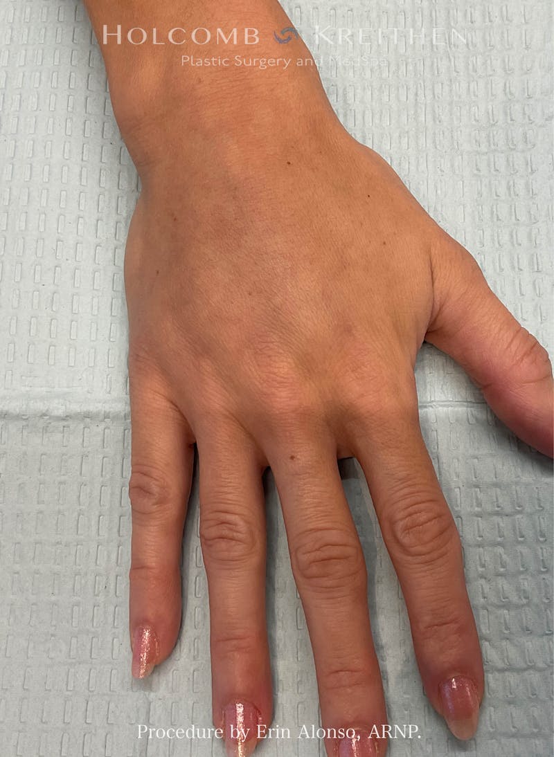 Filler Before & After Gallery - Patient 103393 - Image 2
