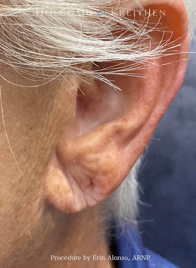 Filler Before & After Gallery - Patient 407801 - Image 1