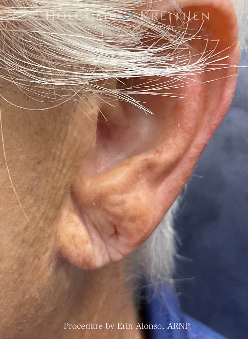 Filler Before & After Gallery - Patient 407801 - Image 1