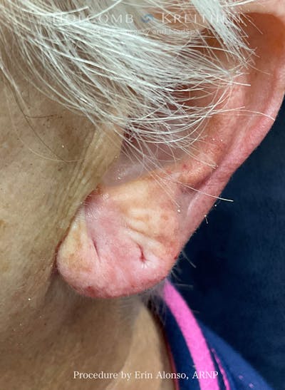 Filler Before & After Gallery - Patient 407801 - Image 2