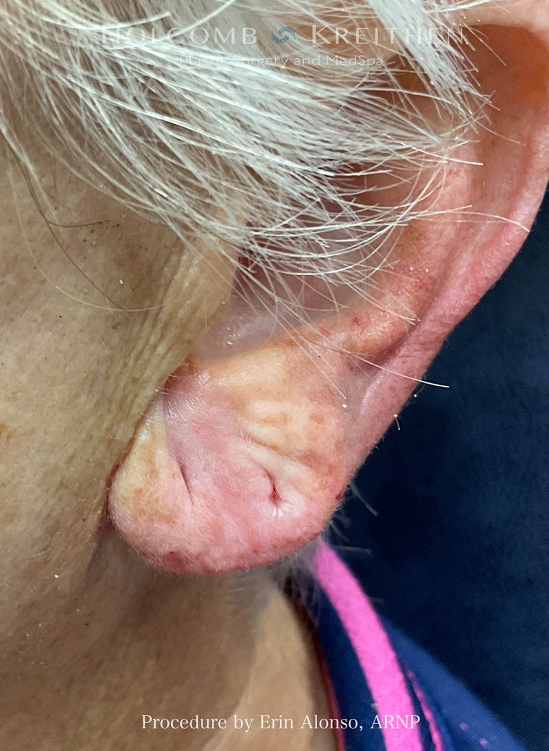 Filler Before & After Gallery - Patient 407801 - Image 2