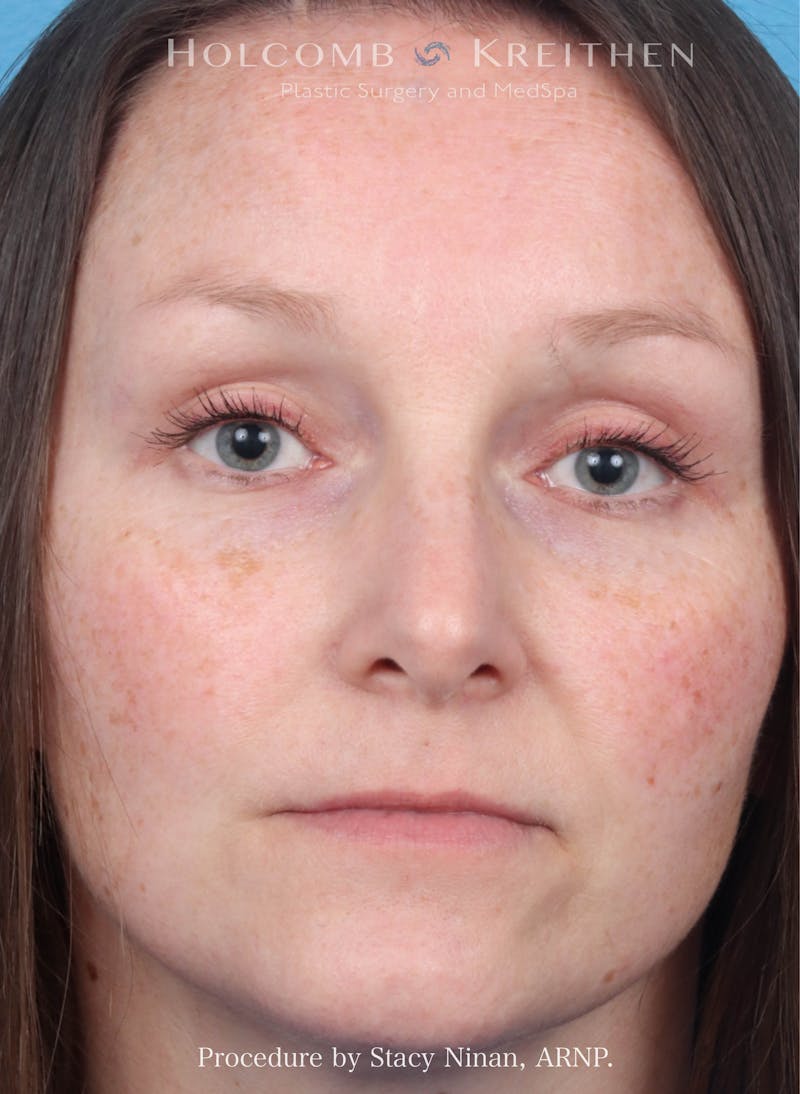 Filler Before & After Gallery - Patient 248648 - Image 1