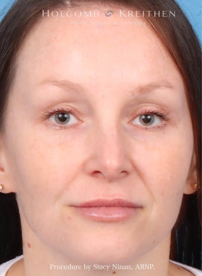 Filler Before & After Gallery - Patient 248648 - Image 2