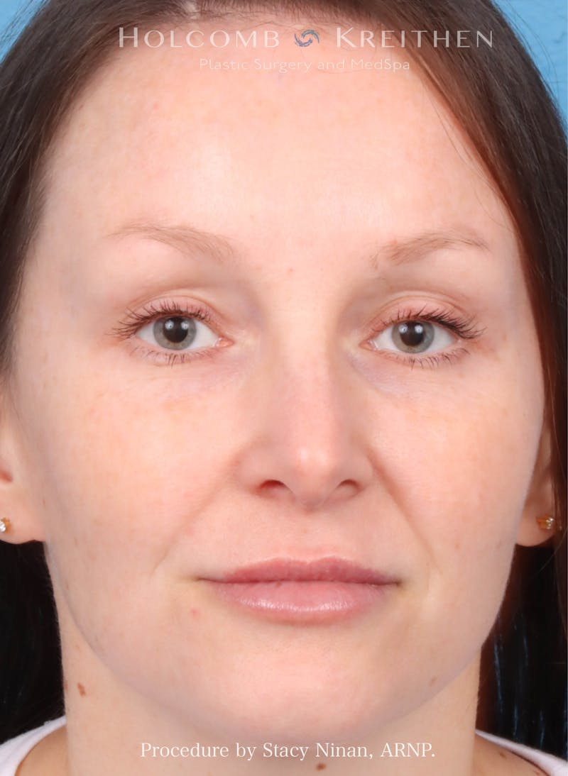 Filler Before & After Gallery - Patient 248648 - Image 2